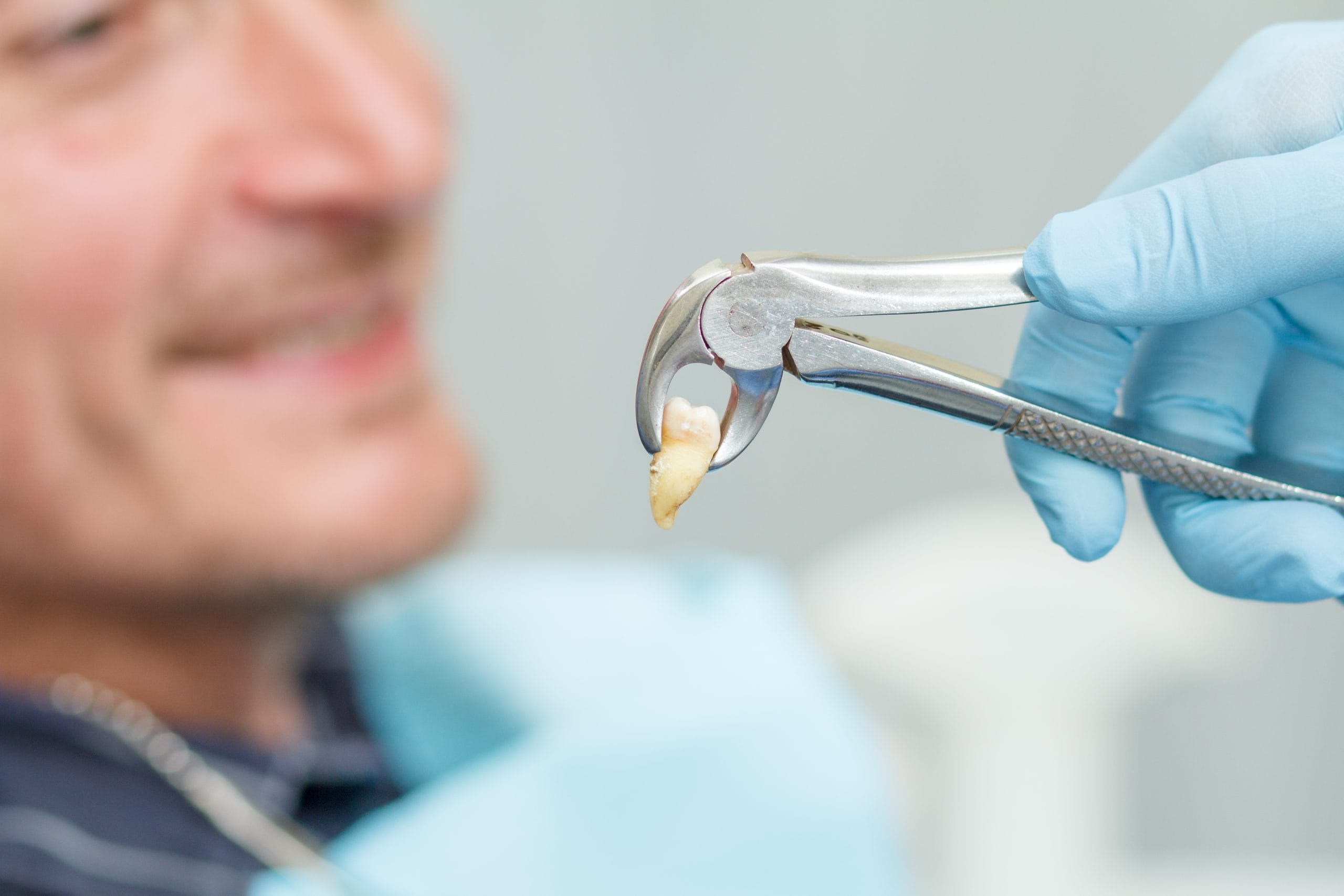 Estrazione dente devitalizzato