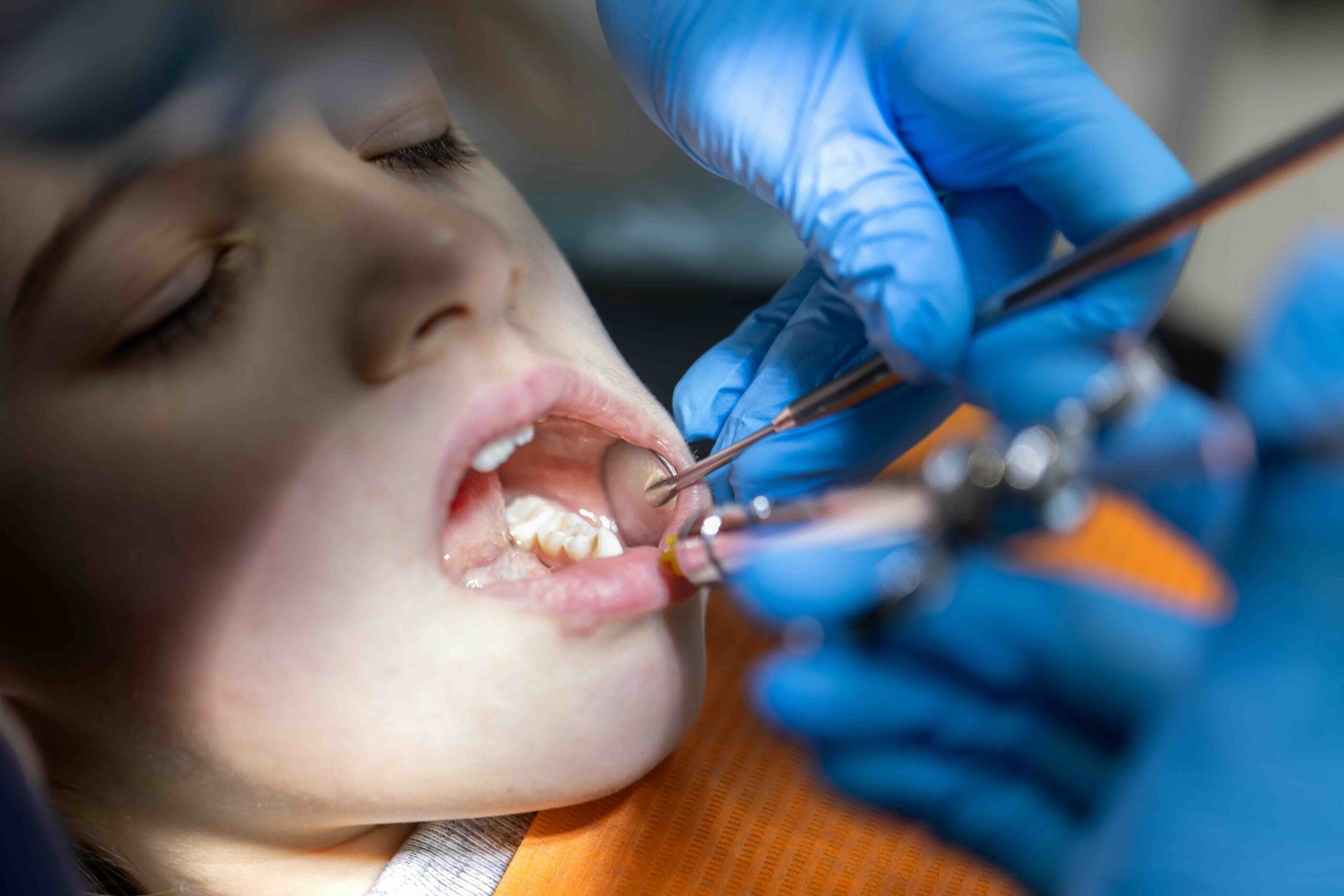 gonfiore dopo estrazione dente da latte